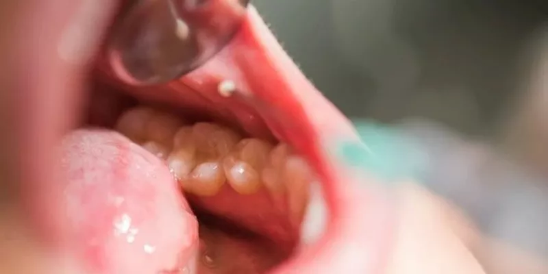 próchnica zębów